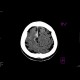 Subarachonid hemorrhage, minute: CT - Computed tomography