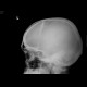 Skull fissure, epidural hematoma: X-ray - Plain radiograph