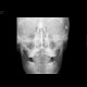 Skull fissure, epidural hematoma: X-ray - Plain radiograph