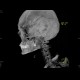 Skull fissure, epidural hematoma: CT - Computed tomography