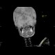 Skull fissure, epidural hematoma: CT - Computed tomography