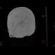 Skull fissure, epidural hematoma: CT - Computed tomography