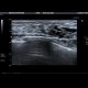 Intraductal papilloma, ectatic ducts: US - Ultrasound