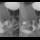 Duodenal bulb ulcer: RF - Fluoroscopy
