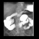 Duodenal diverticulum: RF - Fluoroscopy