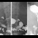 Duodenal ulcer: RF - Fluoroscopy