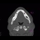 Residual cavity in mandible after extraction of tooth: CT - Computed tomography