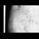 Duverney fracture, fracture of iliac wing: X-ray - Plain radiograph