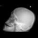 Fracture of the mandible: X-ray - Plain radiograph