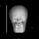Fracture of the mandible: X-ray - Plain radiograph