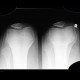 Patellar dysplasia, Wiberg III: X-ray - Plain radiograph