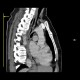 Oesophagitis, corrosive oesophagitis, lye ingestion, CPR: CT - Computed tomography