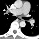 Oesophagitis, corrosive oesophagitis, lye ingestion: CT - Computed tomography