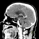 Empty sella, hypophysis: CT - Computed tomography