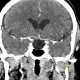 Empty sella, hypophysis: CT - Computed tomography