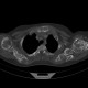 Enchondromatosis, Ollier disease: CT - Computed tomography