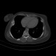 Enchondromatosis, Ollier disease: CT - Computed tomography