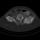 Enchondromatosis, Ollier disease: CT - Computed tomography