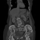 Enchondromatosis, Ollier disease: CT - Computed tomography