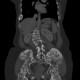 Enchondromatosis, Ollier disease: CT - Computed tomography