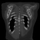 Enchondromatosis, Ollier disease: CT - Computed tomography