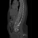 Enchondromatosis, Ollier disease: CT - Computed tomography