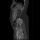 Enchondromatosis, Ollier disease: CT - Computed tomography