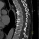End plate disease, grade III, osteochondrosis, vacuum phenomenon: CT - Computed tomography