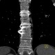 End plate disease, grade III, osteochondrosis, vacuum phenomenon: CT - Computed tomography