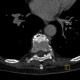 End plate disease, grade III, osteochondrosis, vacuum phenomenon: CT - Computed tomography