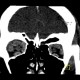 Endocrine orbitopathy, exophthalmus: CT - Computed tomography