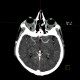 Endocrine orbitopathy, exophthalmus: CT - Computed tomography