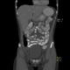 Post-radiation enteritis, enterography, positive contrast: CT - Computed tomography