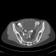 Post-radiation enteritis, enterography, positive contrast: CT - Computed tomography