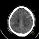 Epidural hematoma, subarachoid hemorrhage, cerebral contusion, skull fissure: CT - Computed tomography