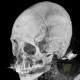 Epidural hematoma, subarachoid hemorrhage, cerebral contusion, skull fissure: CT - Computed tomography