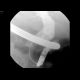 Choledocholithiasis, biliary duct stone, ERCP: RF - Fluoroscopy