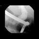 Choledocholithiasis, biliary duct stone, ERCP: RF - Fluoroscopy