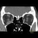Endocrine orbitopathy, exophthalmus: CT - Computed tomography