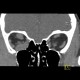 Endocrine orbitopathy, exophthalmus: CT - Computed tomography