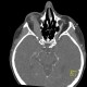 Endocrine orbitopathy, exophthalmus: CT - Computed tomography