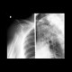 Extraction of head of humerus: X-ray - Plain radiograph