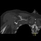 Extraction of head of humerus: CT - Computed tomography