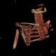Extraction of head of humerus, VRT: CT - Computed tomography