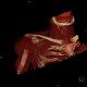 Extraction of head of humerus, VRT: CT - Computed tomography