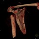 Extraction of head of humerus, VRT: CT - Computed tomography
