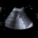 Ascites, echogenic ascites, perofration of stomach ulcer: US - Ultrasound