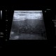 Ascites, echogenic ascites, perofration of stomach ulcer: US - Ultrasound