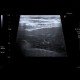 Ascites, echogenic ascites, perofration of stomach ulcer: US - Ultrasound