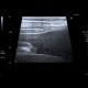 Ascites, echogenic ascites, perofration of stomach ulcer: US - Ultrasound